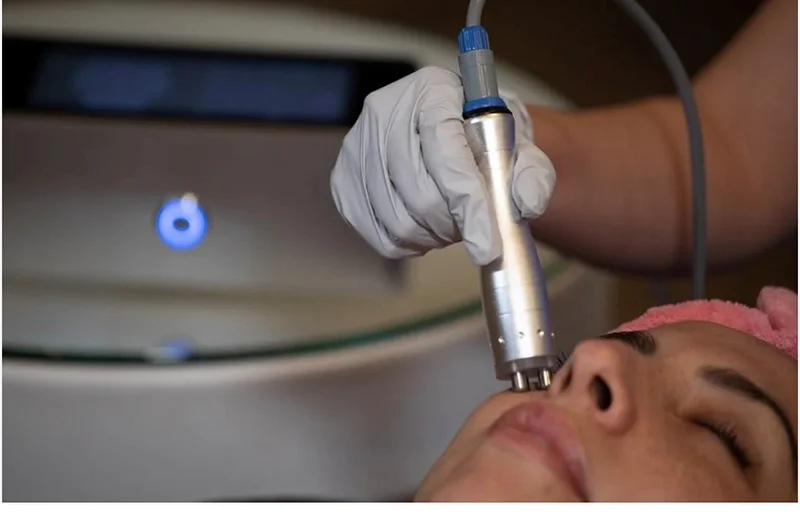 RF Skin Tightening treatment